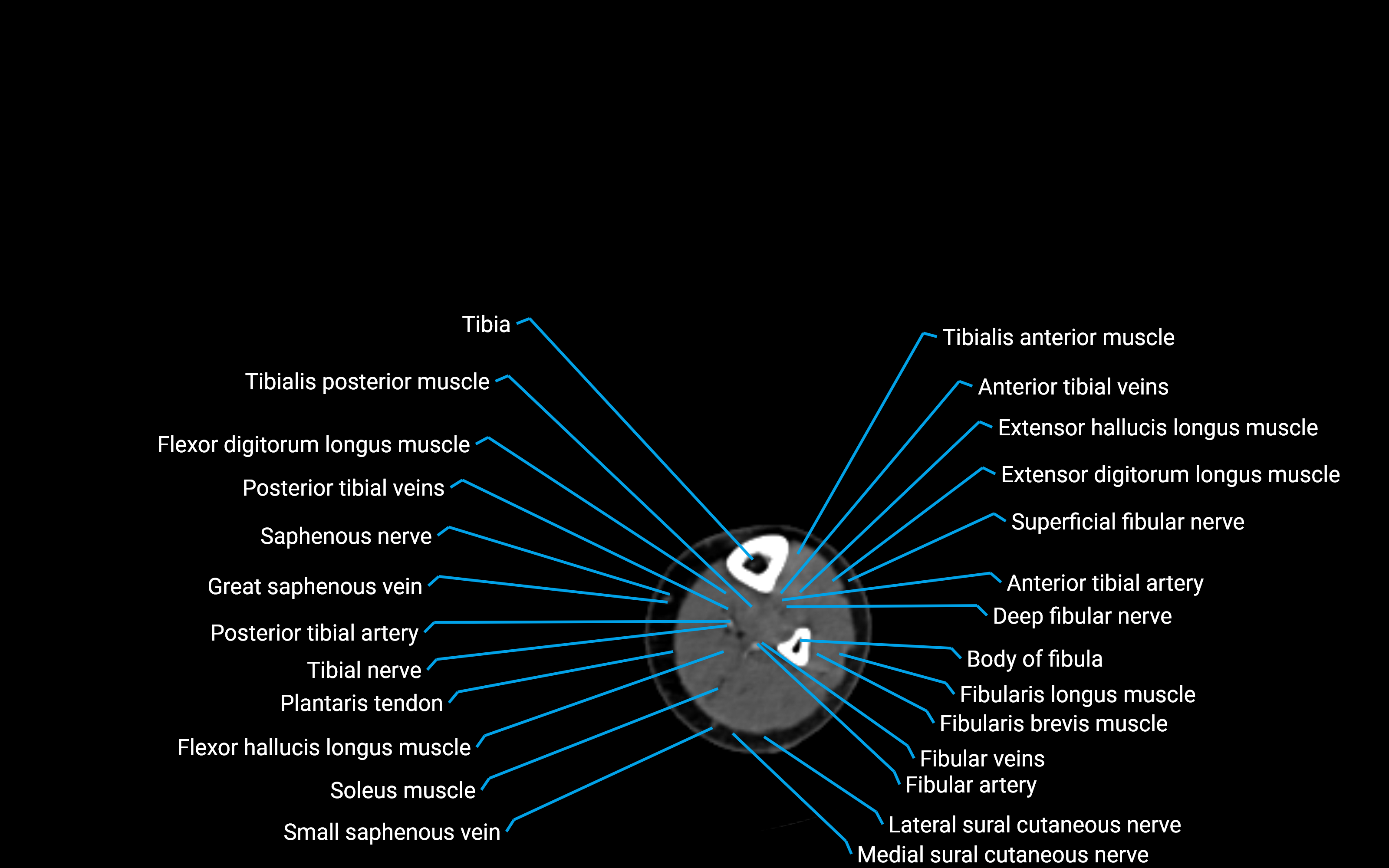 CT Lower leg axial cross sectional anatomy labelled image 132 (2).png